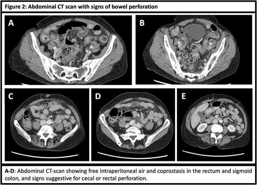 Abdominal CT scan with signs of bowel perforation.