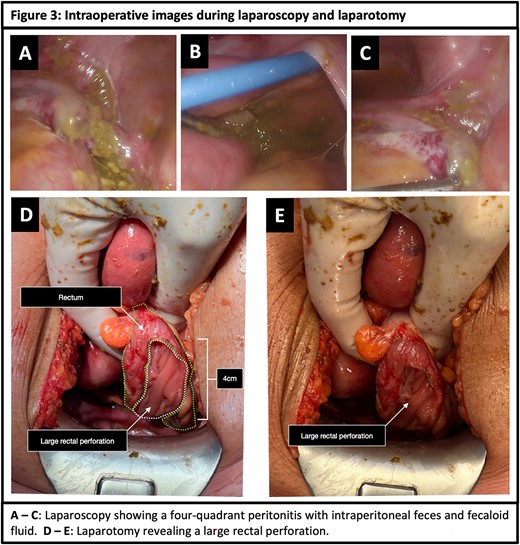 Intraoperative images during laparoscopy and laparotomy.