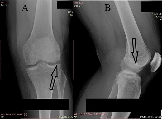 Plain X-ray of the left knee. (A) Anteroposterior view of the left knee with visible bone defect in the lateral femoral condyle (arrow). (B) Lateral view of the left knee with visible free bone fragment (arrow).