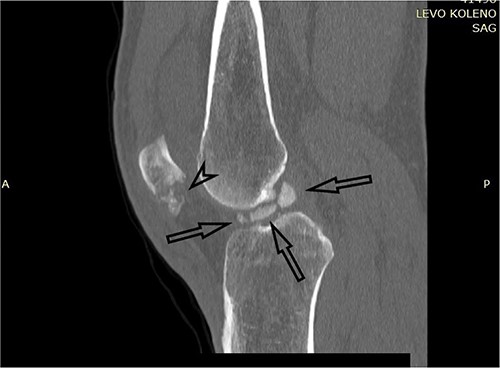 CT scan of the left knee (sagittal) with three fragments (arrows) and patellar fracture (arrowhead).
