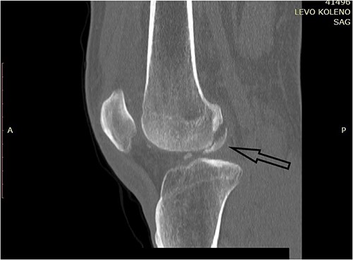 CT scan of the left knee (sagittal) focusing on the largest posterior fragment (arrow).