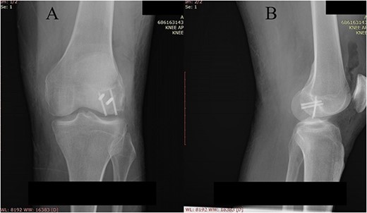 Postoperative plain X-ray of the left knee. (A) Anteroposterior view. (B) Lateral view.