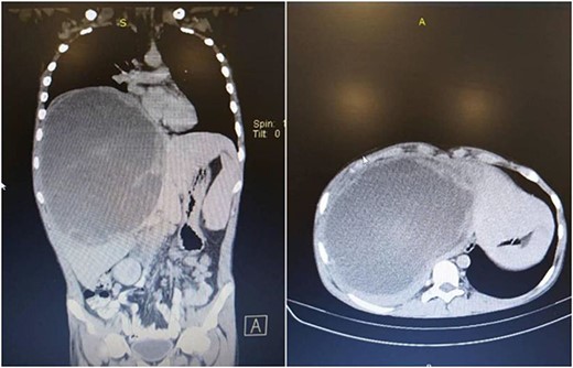 Chest, abdomen, and pelvis CT scan showed a giant heterogeneous mass in the right lobe of the liver.