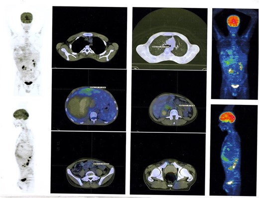 PET Scan Multi Slice revealed a peripherally slightly metabolically active hepatic mass (205 × 134 × 208 mm) with a wide necrotic component and inactive mesenteric, retroperitoneal, and pulmonary nodes.