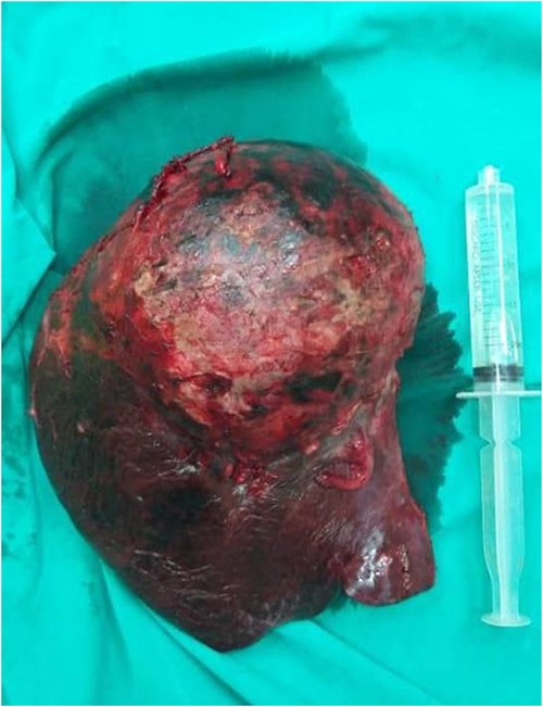 A gross examination of the right hepatic lobe specimen.