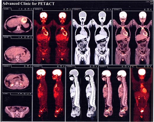 PET Scan Multi Slice showed normal findings without signs of local recurrence, without nodal or visceral metabolic activity.