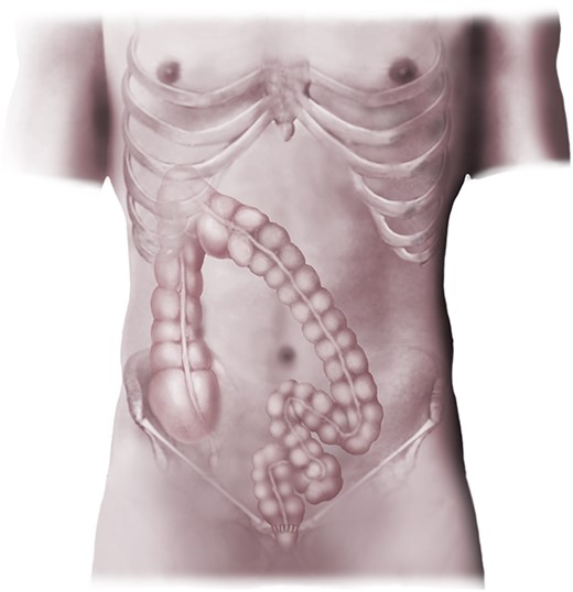 Complete splenic flexure mobilization and anastomosis.
