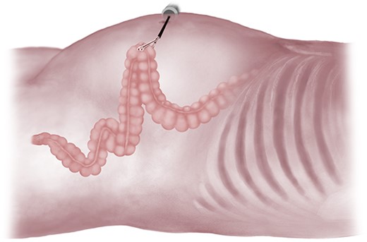 Testing of colonic length after anastomosis.
