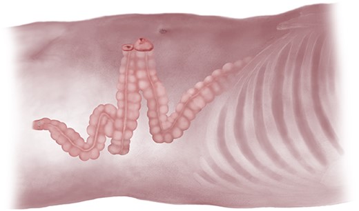 Defunctioning left-sided loop colostomy.