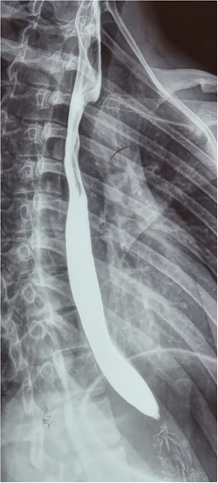 Esophagogram revealing an extrinsic compression above the level of the aortic arch.