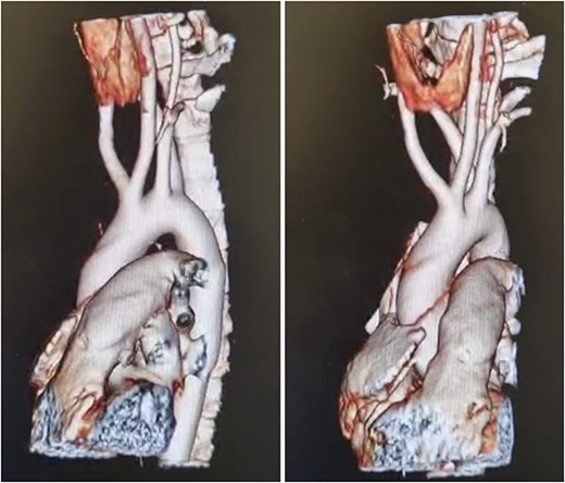(A) CT, showing and ARSA compressing the esophagus, (B) CT, truncus bicaroticus and an ARSA.