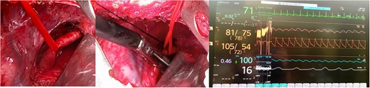 Intraoperative findings, (A) Dissected ARSA, (B) ARSA being clamped with mechanical suture, (C) Monitor showing comparative pressures between upper limbs.