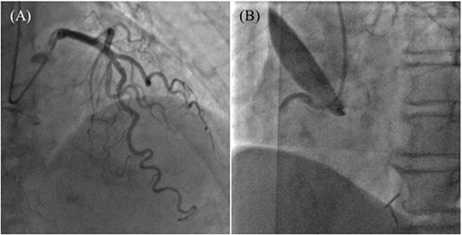 Coronary angiography images. (A) Intact left coronary artery without collateral blood supply into the right coronary artery (RCA). (B) Aortocoronary dissection of RCA with total occlusion.