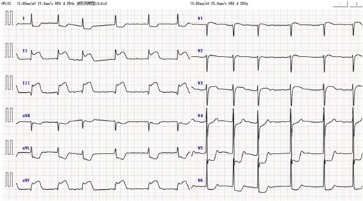 Preoperative electrocardiography. ST elevation in leads II, III, and aVF, and reciprocal ST depression in leads I, aVL, and V4-6 were detected.