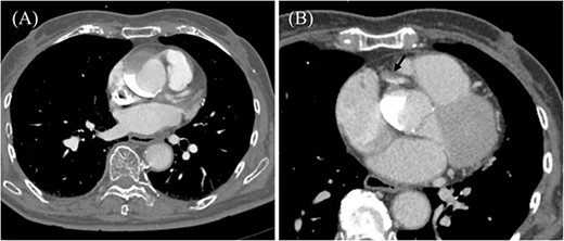Preoperative contrast-enhanced CT. (A) Ascending aortic dissection is detected. Contrast-material is pooled in the false lumen. (B) Dissection at the proximal part of RCA is suspected (black arrow).