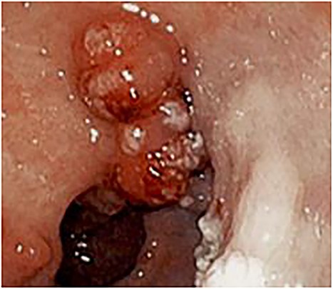 Endoscopy showing 10–20 mm sessile polyps and pseudomembranous-like gray-white exudate overlying the gastric mucosa in the prepyloric and antral regions of stomach.