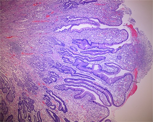 Biopsy of the gastric polyps is consistent with hyperplastic polyps, focally covered by inflammatory volcanic eruption.