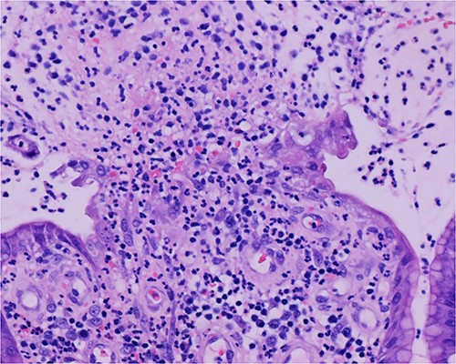Biopsy of the polyp, covered in part by pseudomembranous inflammatory exudate.