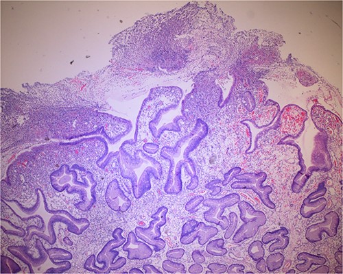 Volcanic-like eruption of inflammatory exudate, reminiscent of pseudomembranous gastritis.