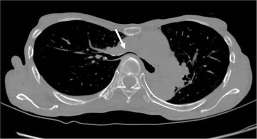 Chest CT findings of severe PE with stenosis of the right main bronchus. The right main bronchus was severely narrowed with a HI (HI) of 8.9 (arrow).