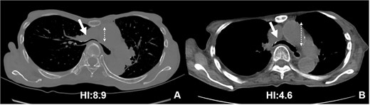CT scans are used to monitor changes over time. In (A), chest CT findings of severe PE with stenosis of the right main bronchus. The trachea, which was centrally located on CT scan 8 years ago (2B), has shifted to the left now (2A). Additionally, the CT-HI worsened over his 8 years, increasing from 6.8 to 8.9.