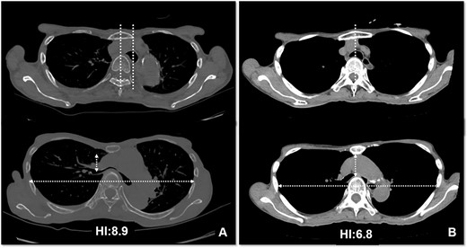 Pre- (A) and postoperative (B) CT findings: the Nuss procedure improved the chest wall and right main bronchus stenosis, and reduced HI from 8.9 to 4.6.