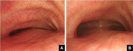 Pre- (A) and postoperative (B) bronchoscopic findings. Preoperatively, the right main bronchus is severely stenotic (A). The stenosis of the right main bronchus improves after performing the Nuss procedure (B).