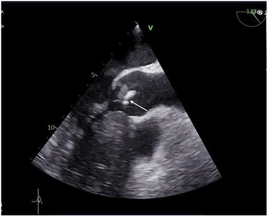 Preoperative transthoracic echocardiogram (TTE) showing vegetation on the aortic valve.