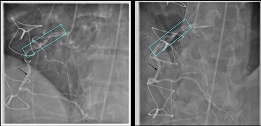 Coronary Angiogram showing RCA dissection extending from ostium to mid-vessel (box), normal coronary artery (arrow).