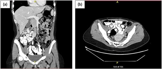CT AP post oral and intravenous contrast; (a) coronal view and (b) axial view showing multiple mildly dilated small bowel loops, suspicious for developing SBO, with transition point in the right lower pelvis, where there is possible focal mural thickening, and no perforation; the appendix appeared normal.