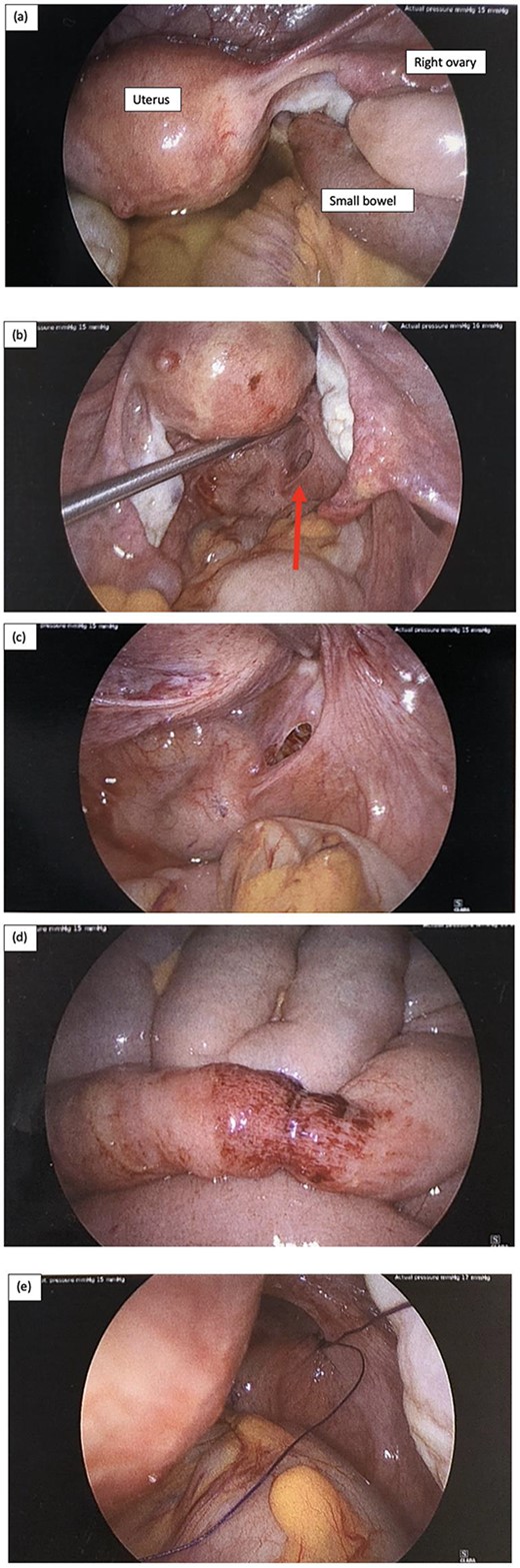 Intraoperative laparoscopy findings, and (a) key landmarks including the uterus and right ovary are identified, as well as a short segment of small bowel diving deep into the pelvis, and there is also moderate volume of serous free fluid; (b) serous fluid has been suctioned and there is small bowel herniating through a small peritoneal defect adjacent to the rectum on the right represented by the red arrow; (c) peritoneal defect in the POD; (d) the short segment of small bowel that was involved incarcerated in the hernia has a small area of bruising but is otherwise viable, and (e) the peritoneal defect was repaired with a single figure of 8 stich using 0 PDS suture.