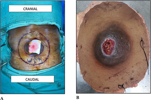 (A) Photograph of the lesion to the lower back. (B) Photograph of the wide local excision.