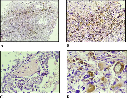 (A) Non-circumscribed lesion displaying sheet-like and fascicular growth of spindle and pleomorphic cells with haemosiderin deposition (×40). (B) Markedly pleomorphic cells in nondescript growth pattern with abundant haemosiderin deposition (×100). (C) Fibrin surrounded by inflammatory cells and atypical endothelial cells (×400). (D) Markedly pleomorphic cells with abundant eosinophilic cytoplasm and large, irregular, hyperchromatic nuclei with prominent intranuclear pseudo-inclusions (×400).