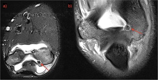 OO localization with contrast MRI: (a) coronal view and (b) frontal view.