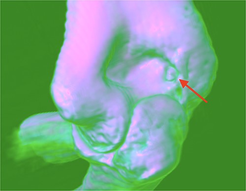 OO localization with 3D CT scan.