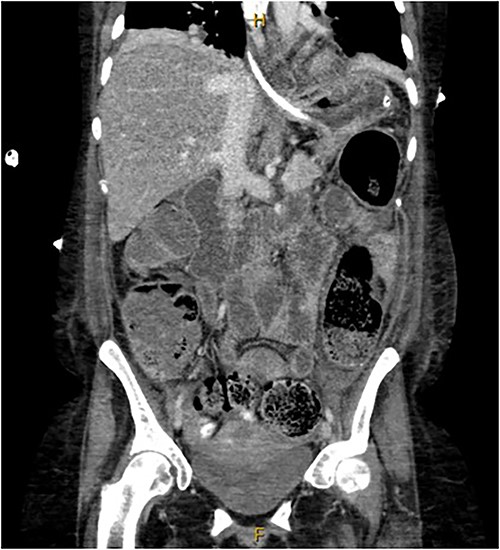 Coronal view of CT abdomen demonstrating normal large bowel wall enhancement with faecal loading.