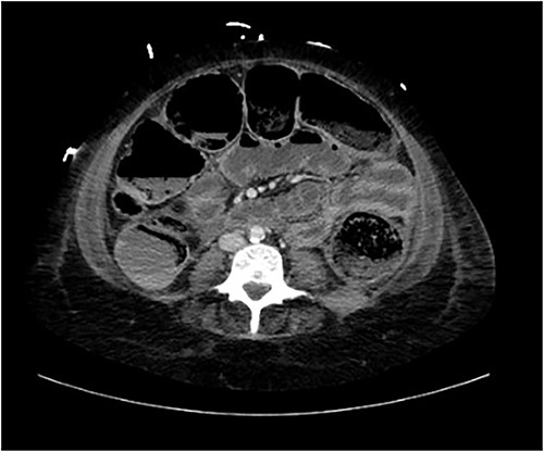 Axial view of CT abdomen demonstrating normal large bowel wall enhancement with faecal loading.