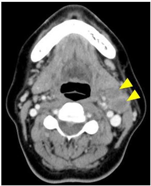 Contrast-enhanced CT is showing enlarged left cervical lymph nodes with ring enhancement (arrowheads).