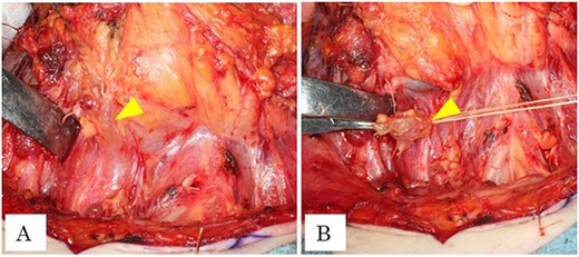 (A) Intraoperative photograph is showing dilation of thoracic duct (arrowhead). (B) Intraoperative photograph is showing ligation of thoracic duct (arrowhead).