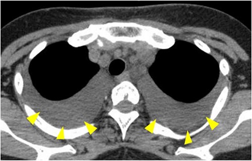CT showing pleural effusion in both lower lung fields (arrowheads).