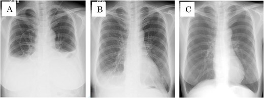 (A) Chest x-rays before bilateral thoracic puncture. (B) Chest X-ray 7 days after bilateral thoracic puncture. (C) Chest X-ray 16 days after bilateral thoracic puncture.