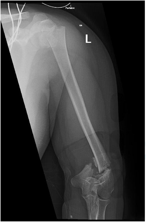 Anteroposterior (AP) view of the left humerus and elbow pre-operative.