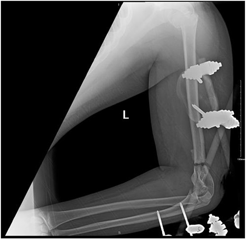 Anteroposterior (AP) view of the left humerus and elbow after Ex-fix application.