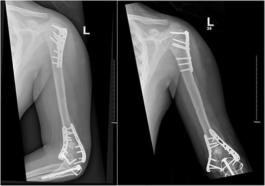 Anteroposterior (AP) view of the left humerus and elbow after ORIF.