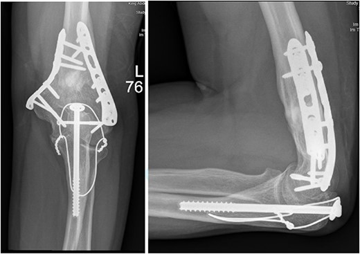 (A). Late follow-up anteroposterior (AP) view of the left elbow after ORIF. (B) Late follow-up lateral view of the left elbow after ORIF.