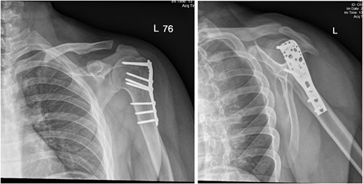 (A) Late follow-up anteroposterior (AP) view of the left shoulder after ORIF. (B) Late follow-up lateral scapula (Y- view) view of the left shoulder after ORIF.
