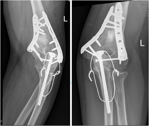 (A) Late follow-up internal oblique view of the left elbow after ORIF. (B) Late follow-up external oblique view of the left elbow after ORIF.