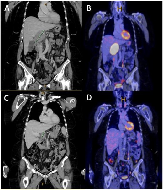 (A and B) Coronal slice of surveillance CT and FDG PET showing a 44 × 56 × 78 mm PET avid exophytic lesion abutting the caudate lobe extending into portocaval space suspicious for metastatic melanoma, given the patients history of cutaneous melanoma; (C and D) coronal slice of CT and FDG PET post three cycles of dual immunotherapy, showing complete metabolic response and significant reduction in size of the metastatic lesion demonstrated in (A) and (B).