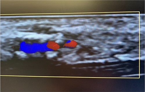 Color flow doppler distinguishing between arterial versus venous flow.