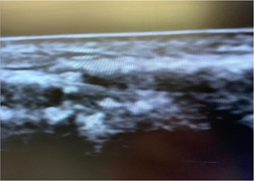 Non-color doppler showing retained arterial line.